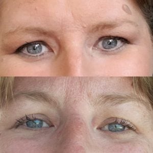 eyes before and after