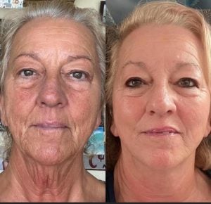 woman 4 before and after
