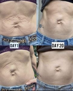 stomach before and after