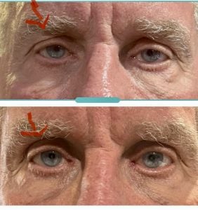 eyes before and after