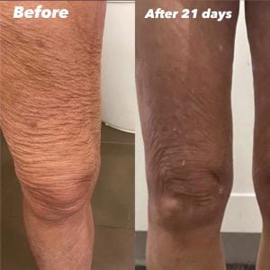 legs before and after